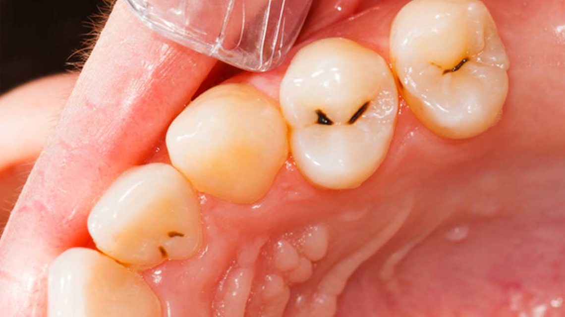 Finding the Best Material for Filling a Tooth Cavity - West