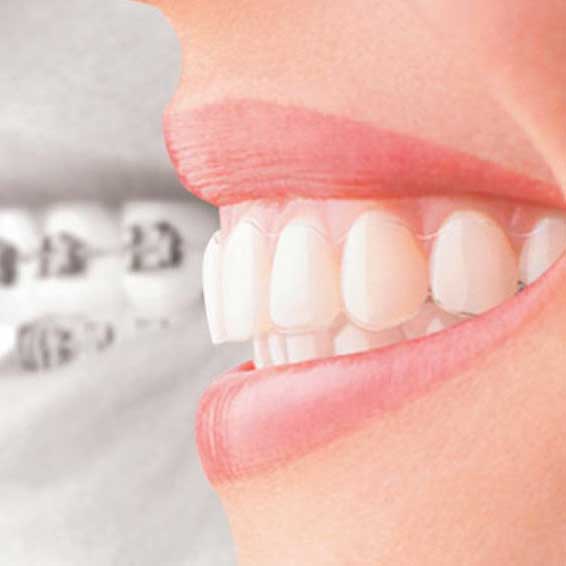 Invisalign West Hollywood 
