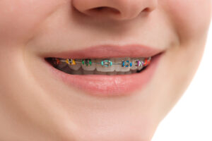 west hollywood color braces