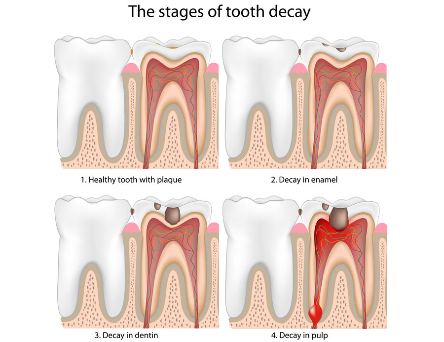 stages of tooth decay