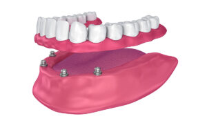all on 4 dental implants West Hollywood