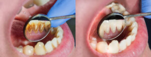 teeth cleaning cost Los Angeles