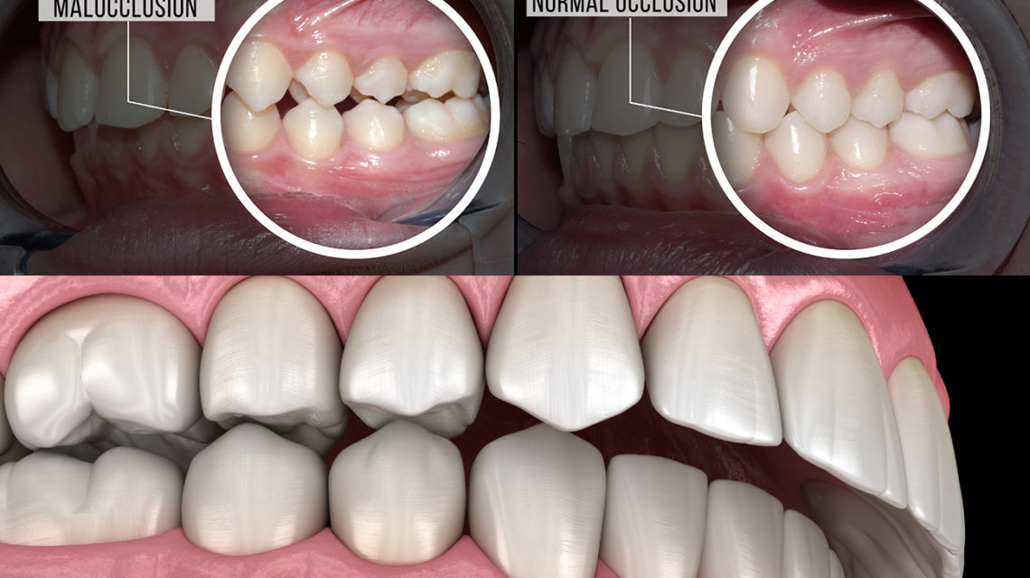 Overbite and Underbite Treatment in Los Angeles, CA - Misaligned teeth  Treatment