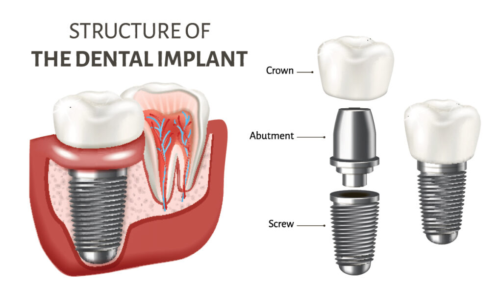 structure of the dental implant