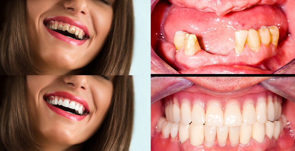 Full Mouth Reconstruction before after