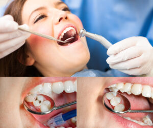 Dental Fillings Cost Los Angeles