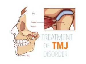 TMJ treatment Los Angeles