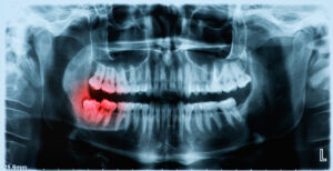 Broken Wisdom teeth