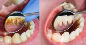 Dental Plaque and Tartar
