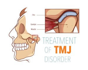 TMJ treatment options