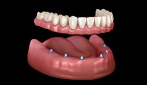 Overdentures