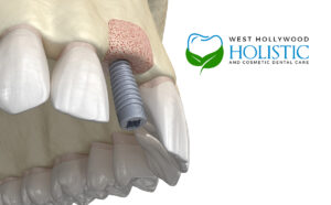 Bone Graft Dental Implants