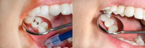 dental fillings cost Los Angeles