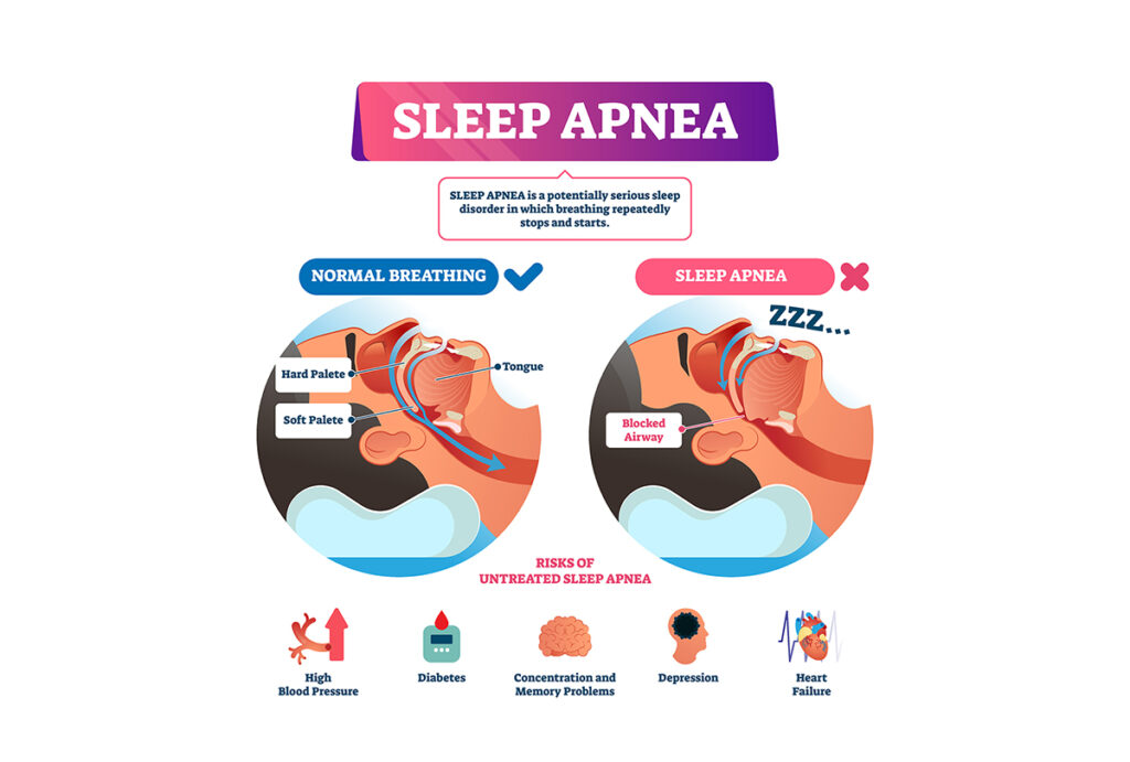 importance of sleep apnea treatment