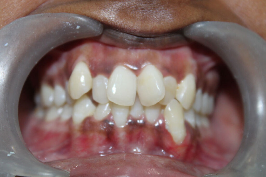crowded teeth treatment