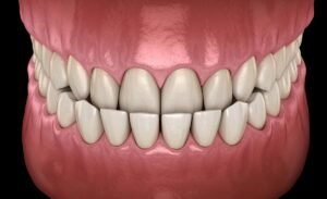 underbite treatment
