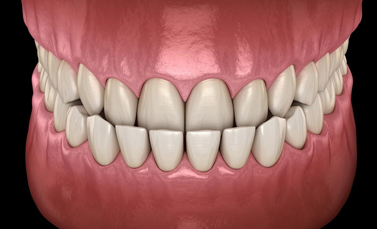 underbite teeth braces