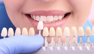 who is a candidate for veneers