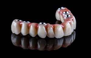full mouth dental implants Los Angeles