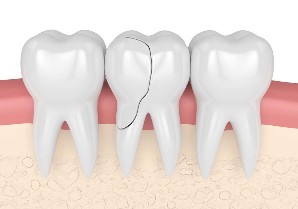 cracked teeth treatment Los Angeles