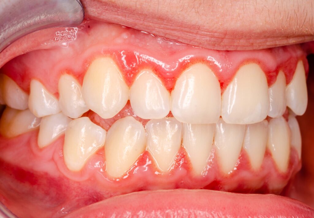 gingivitis