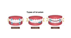 bruxism