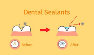 Dental Sealant for Kids