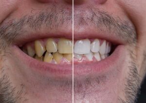 Yellow Teeth Treatment