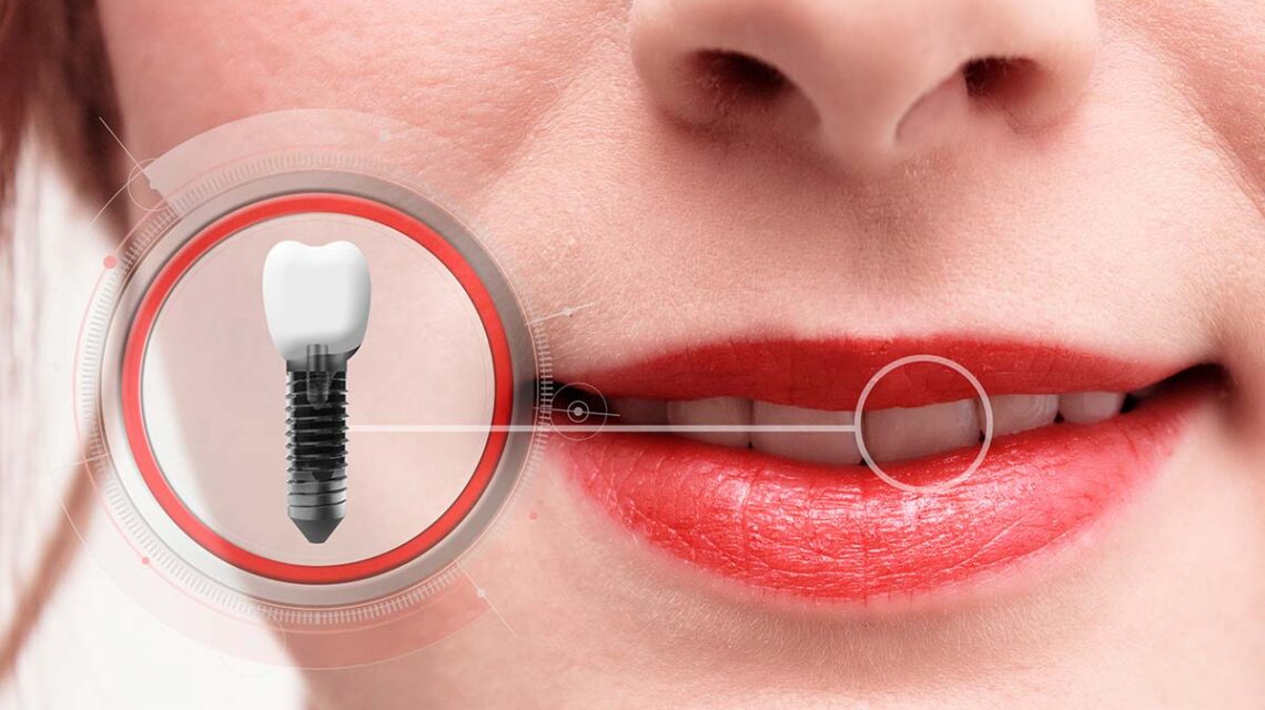 dental implants front tooth