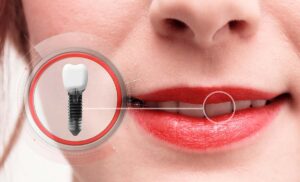 dental implants front tooth
