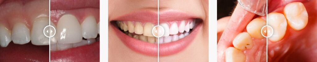 Before And After of Patients
