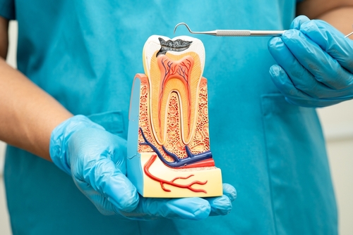 Root Canals
