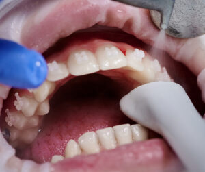 fluoride-free dentistry