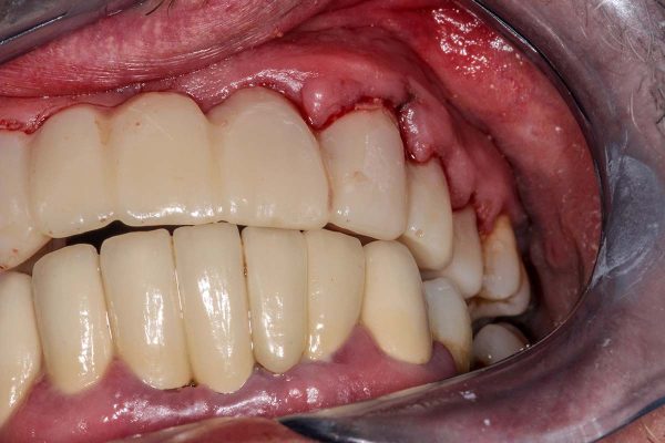 Periodontal Disease
