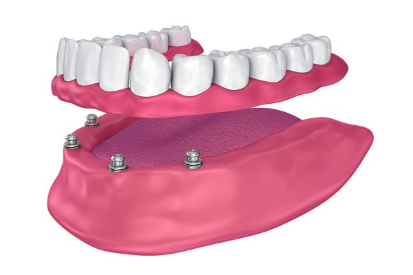 all on 4 dental implants West Hollywood