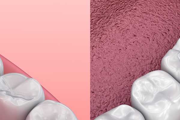 Amalgam removal Los Angeles