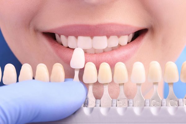who is a candidate for veneers