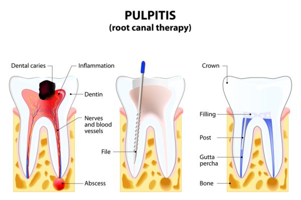 Pulpitis. root canal therapy. Infected pulp is removed from the tooth and the space occupied by it is cleaned and filled with a gutta percha. Post inserted to support crown