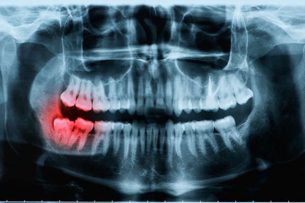 Broken Wisdom teeth