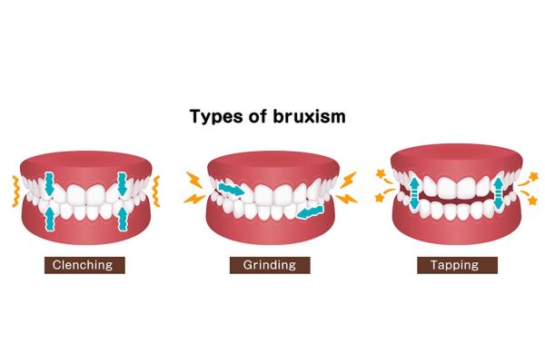 bruxism