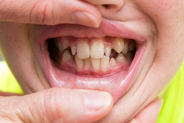 Crooked teeth treatment Los Angeles
