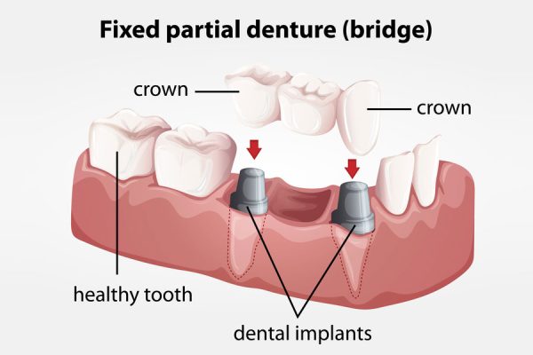 dental-bridges-west-hollywood
