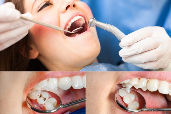 Dental Fillings Cost Los Angeles