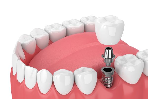 dental implants life span