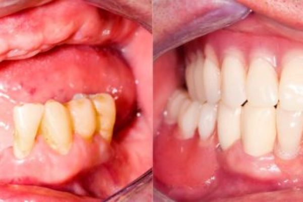 dental implants Los Angeles