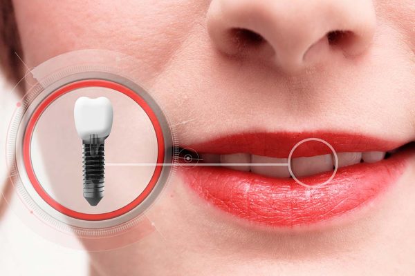dental implants front tooth