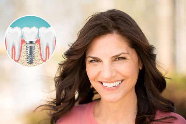 dental implants options West Hollywood