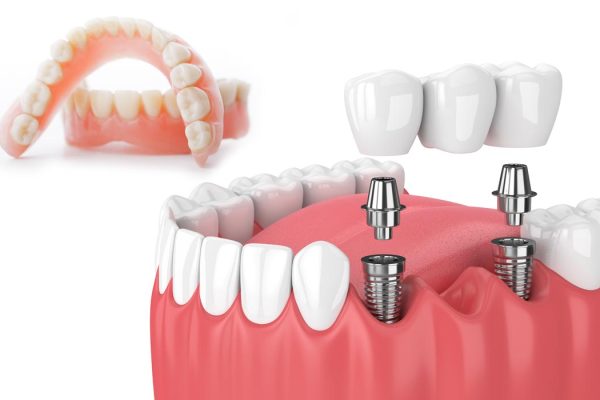 dentures vs implants