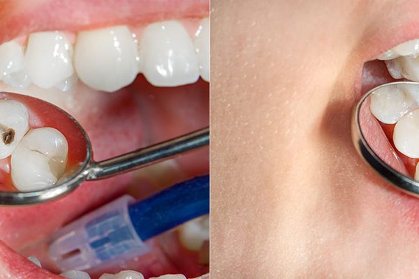 dental fillings cost Los Angeles