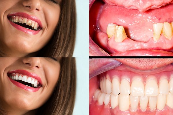 Full Mouth Reconstruction before after